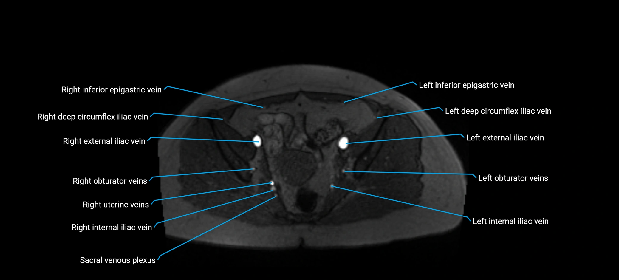 MRV abdomen pelvis & lower limb axial cross sectional anatomy labelled MRI image 157 (1).webp